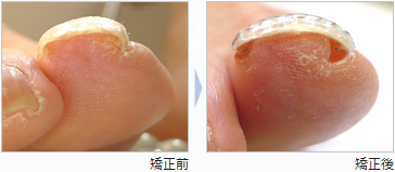 巻き爪自分で治す