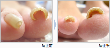 巻き爪自分で矯正